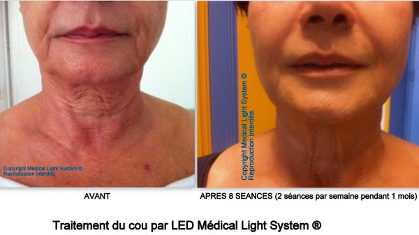 Traitement du raffermissement et du rajeunissement du cou par LED Médical Light System ®