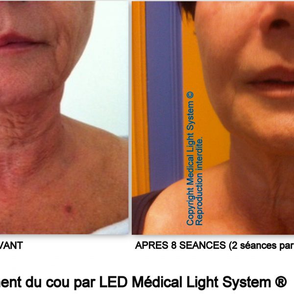 Traitement du raffermissement et du rajeunissement du cou par LED Médical Light System ®